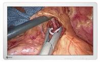 EIZO CuratOR EX2721 full HD surgical display